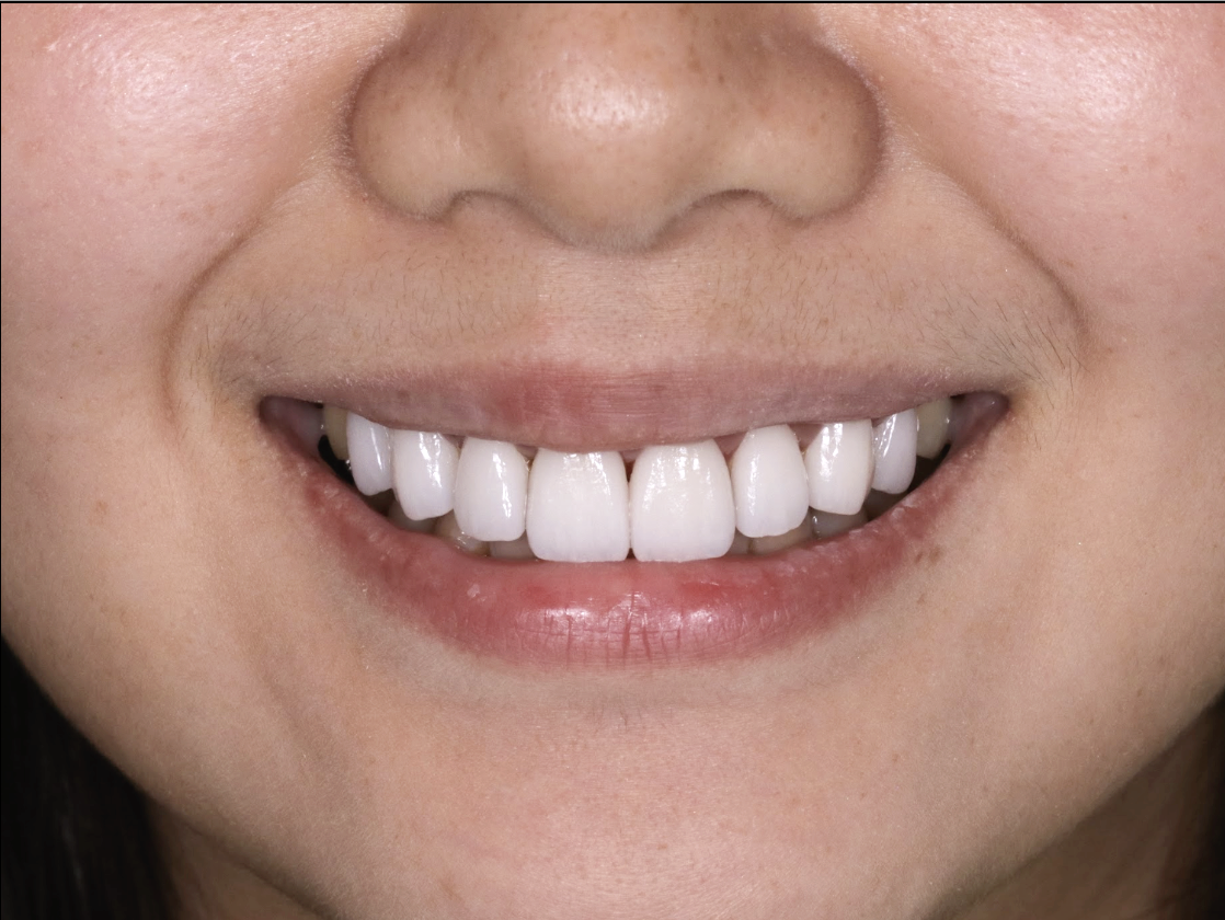 別再讓牙齒黑歷史讓你露出尷尬微笑,i-Smile can help !