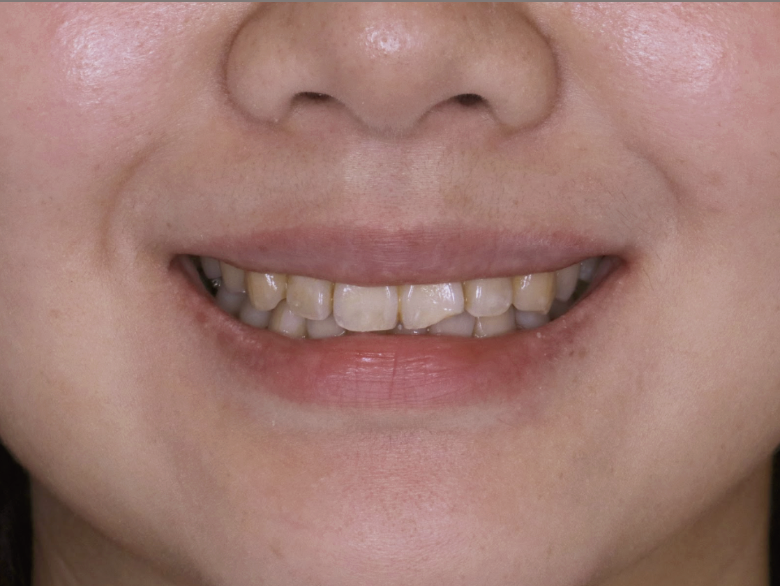 別再讓牙齒黑歷史讓你露出尷尬微笑,i-Smile can help !