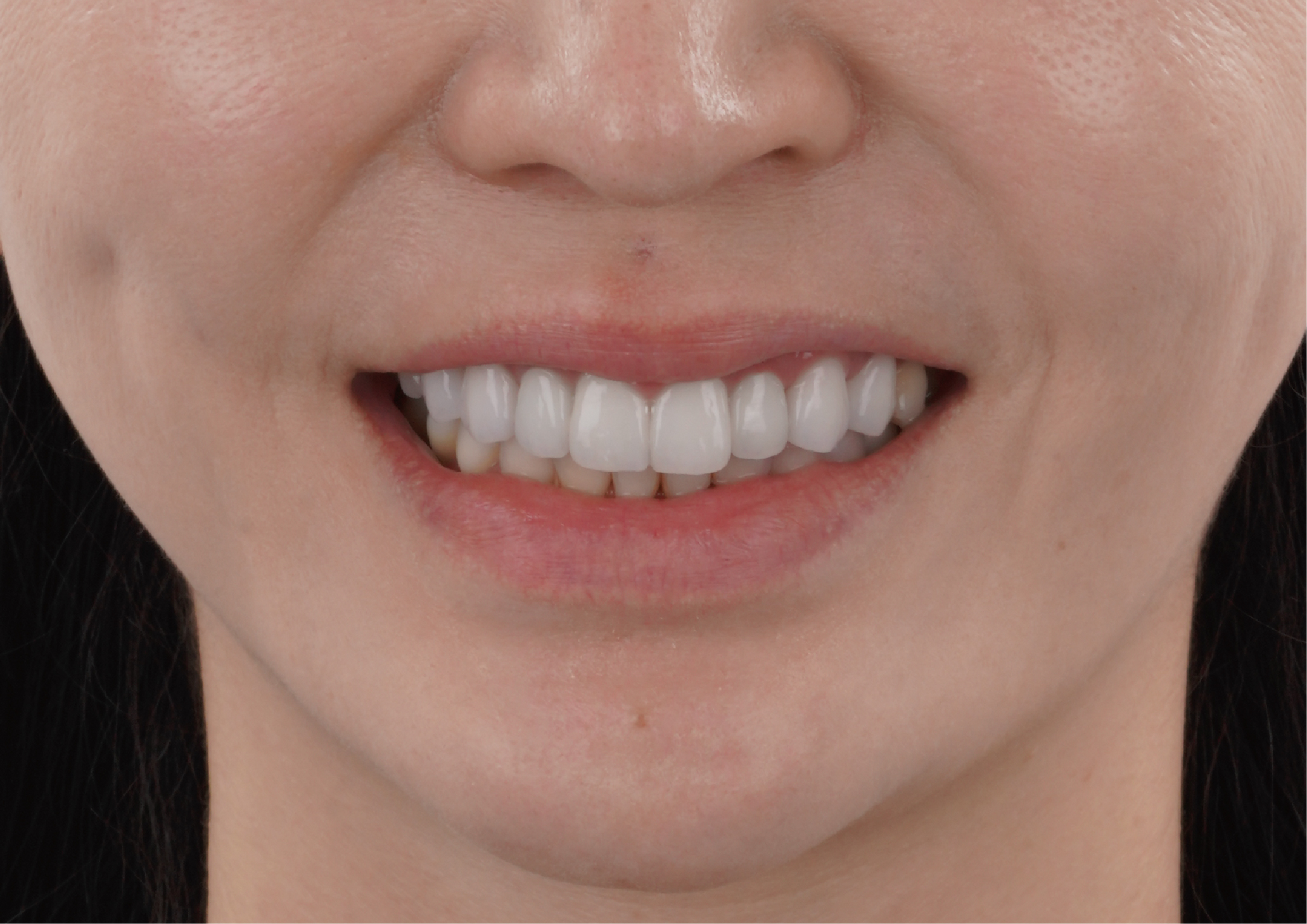 良好的美感溝通與專業的建議～是Jessie最終選擇玩美牙醫的關鍵原因！