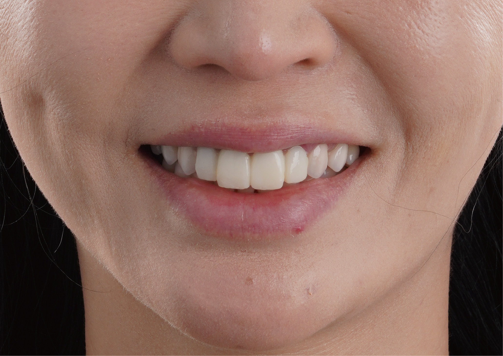 良好的美感溝通與專業的建議～是Jessie最終選擇玩美牙醫的關鍵原因！