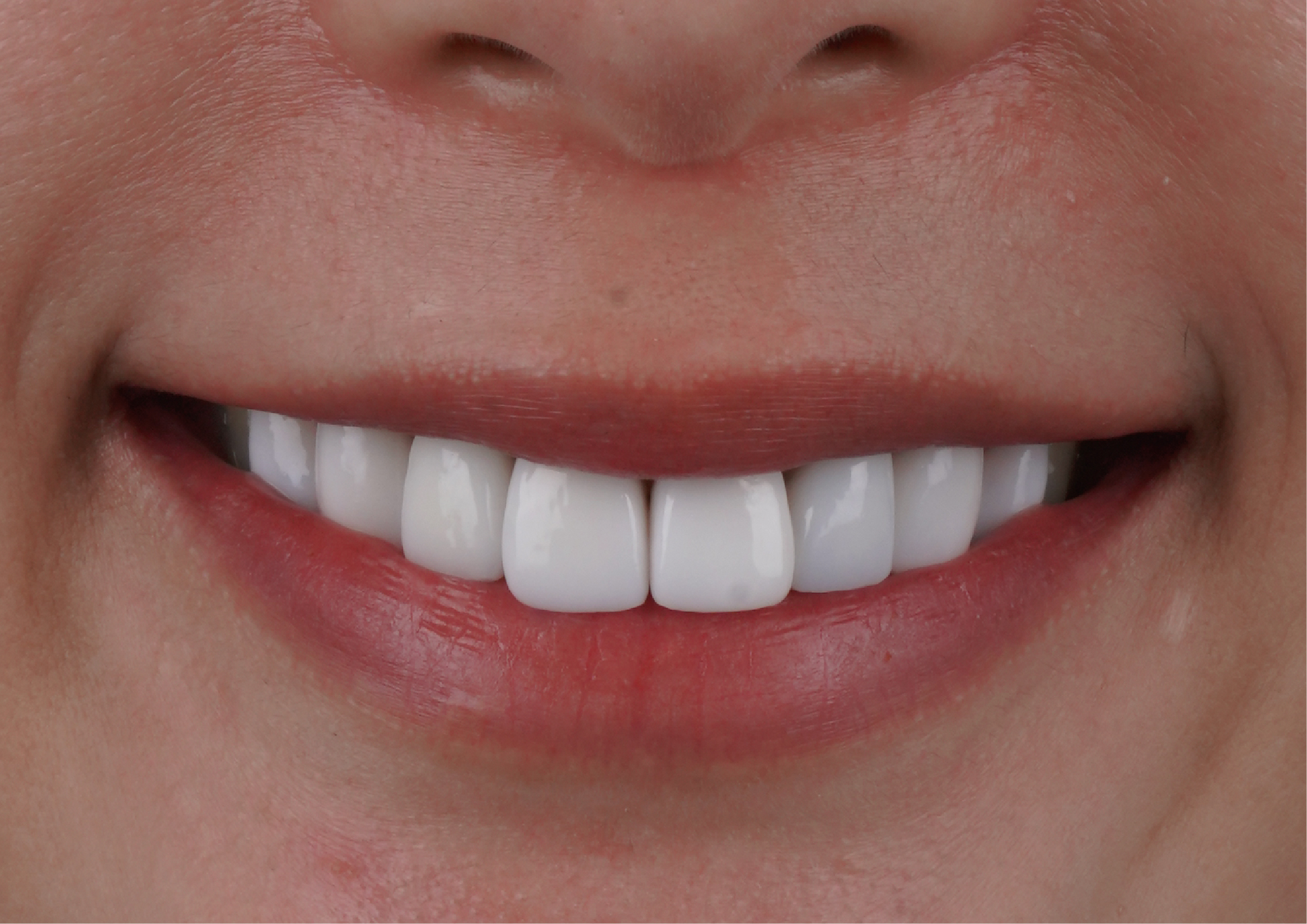 做完牙齒反而不敢笑？！ KUMO超雷經驗教你如何一次就選對玩美微笑～