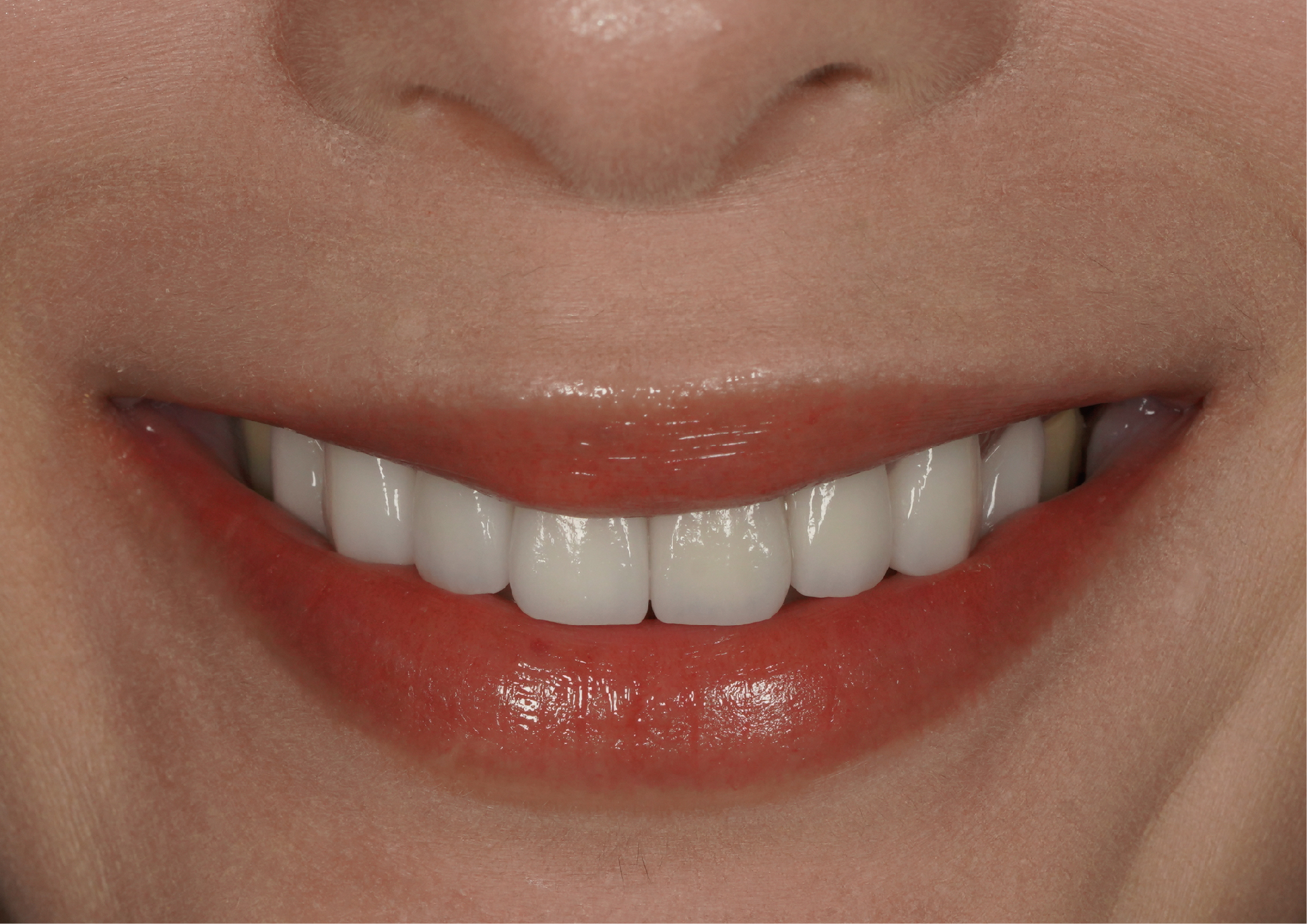 做完牙齒反而不敢笑？！ KUMO超雷經驗教你如何一次就選對玩美微笑～