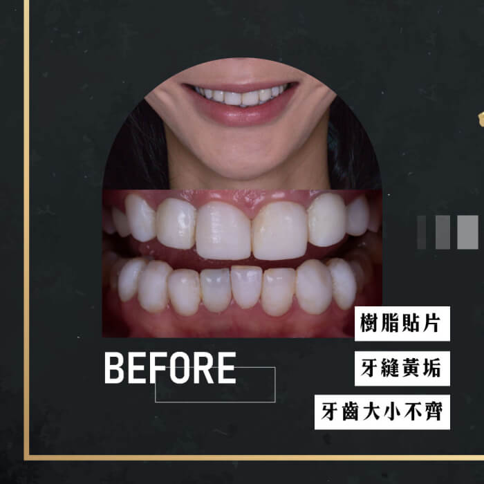 換掉不良的樹脂貼片~微笑品味不尷尬