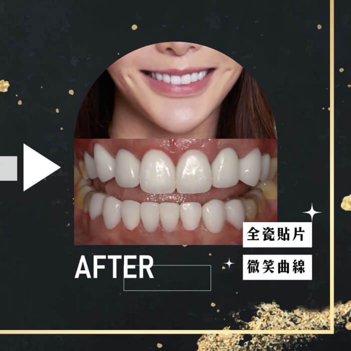 換掉不良的樹脂貼片~微笑品味不尷尬