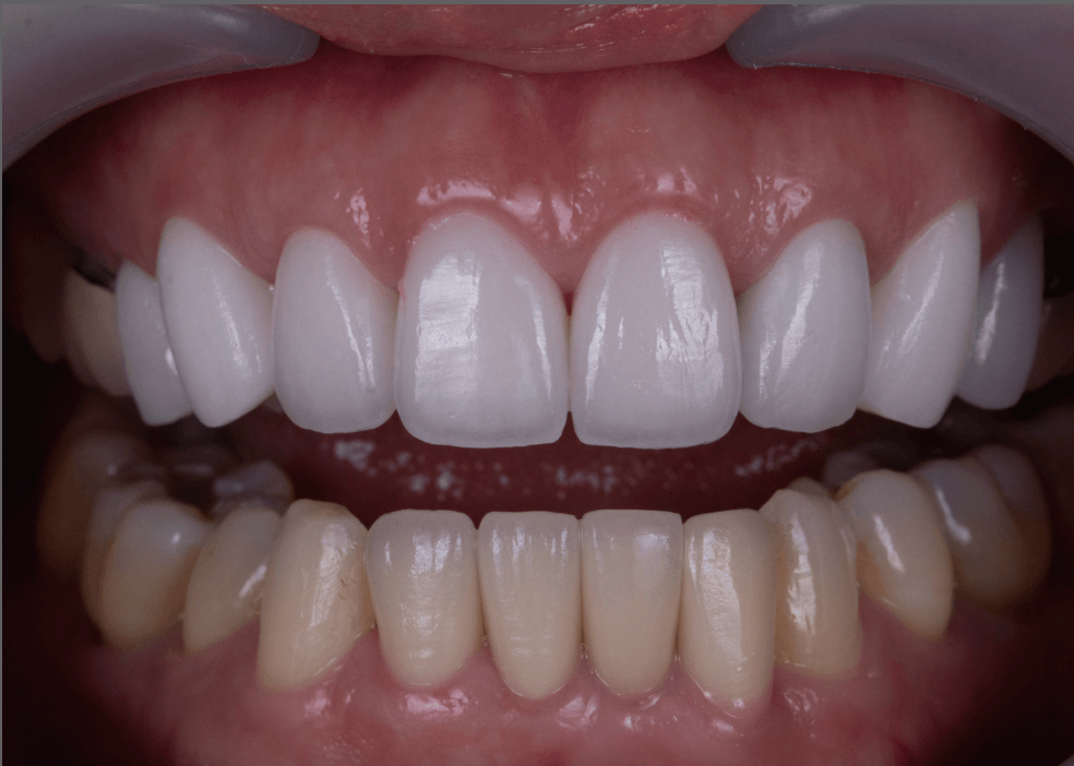 玩美笑容貼片客製│改善笑齦│氣質昇華不費心~