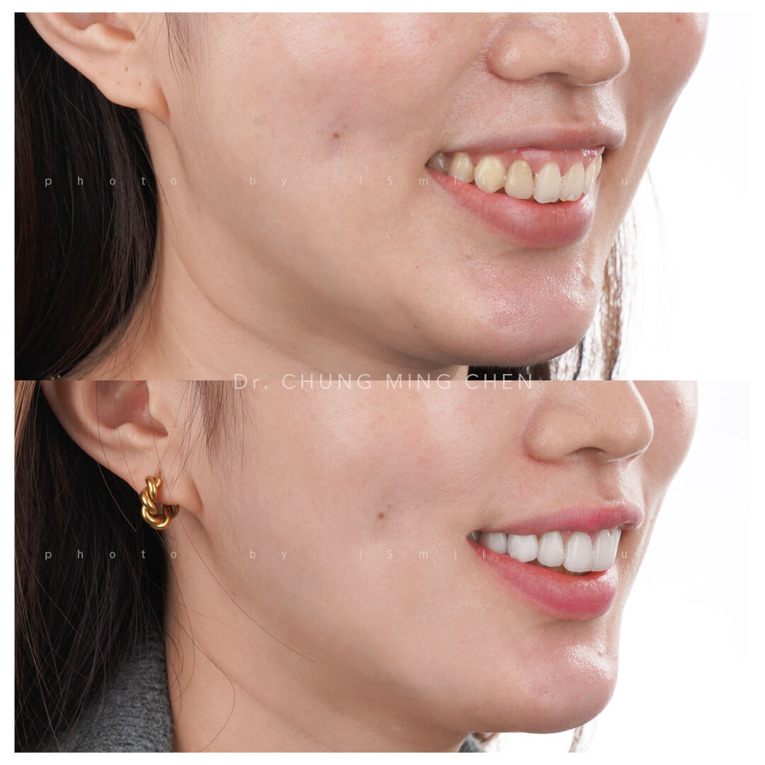 差一點點差很多~MIA矯正後的玩美再造!