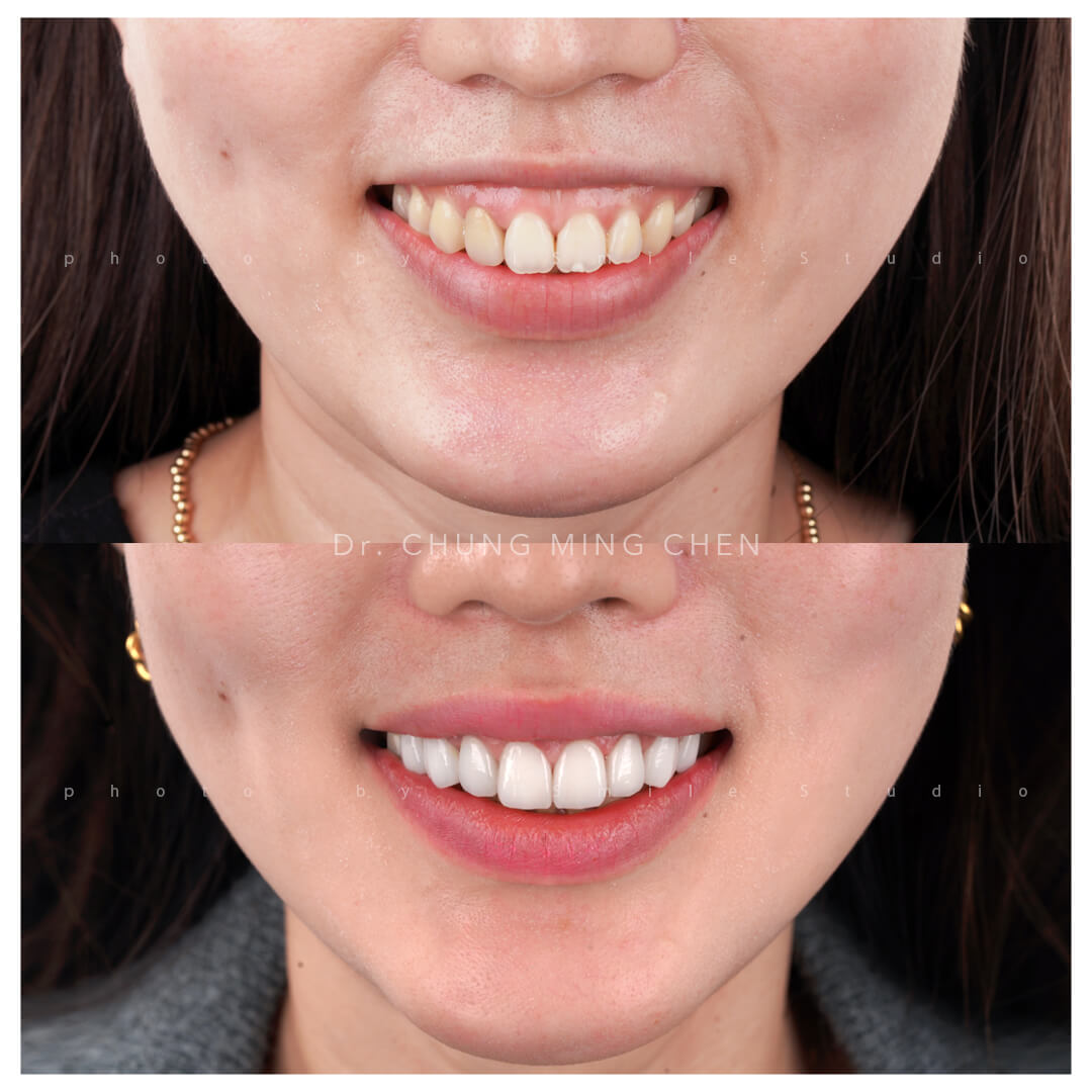 差一點點差很多~MIA矯正後的玩美再造!