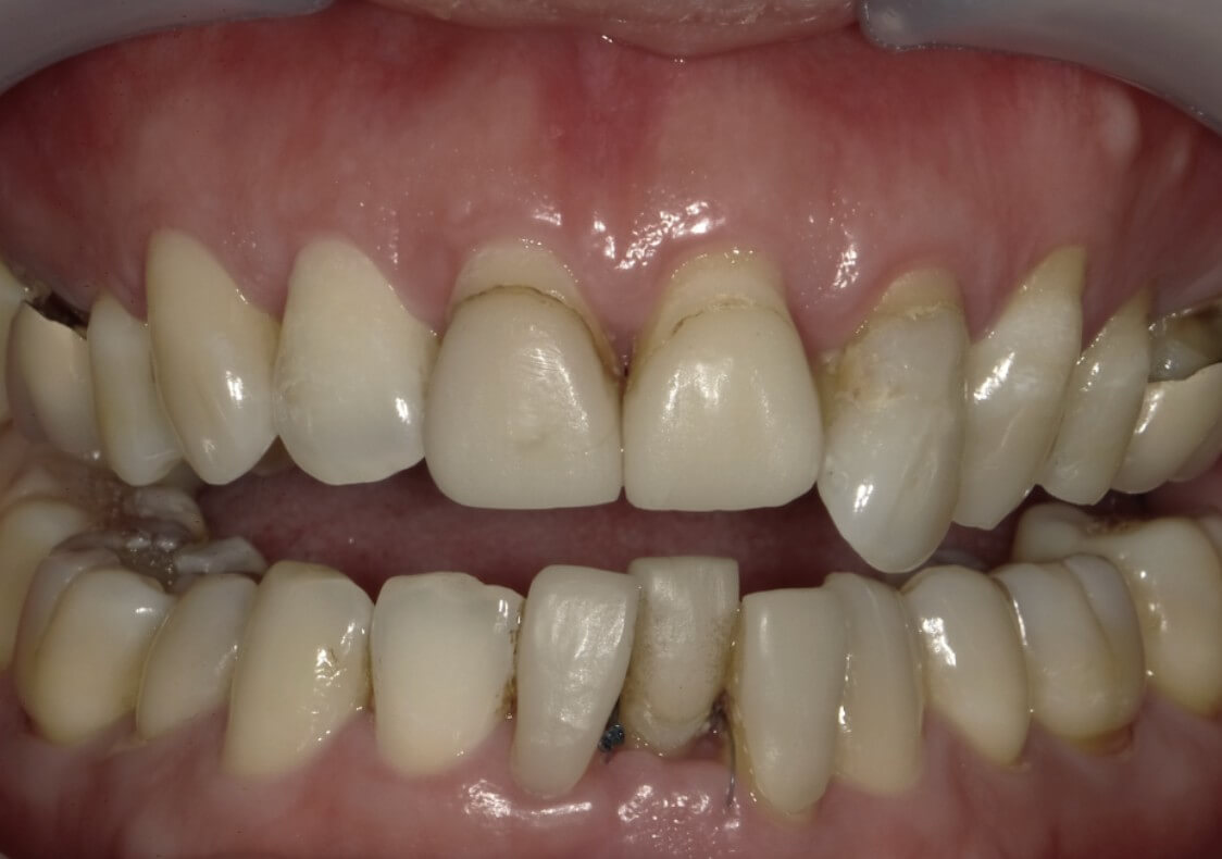 玩美笑容貼片客製│改善笑齦│氣質昇華不費心~