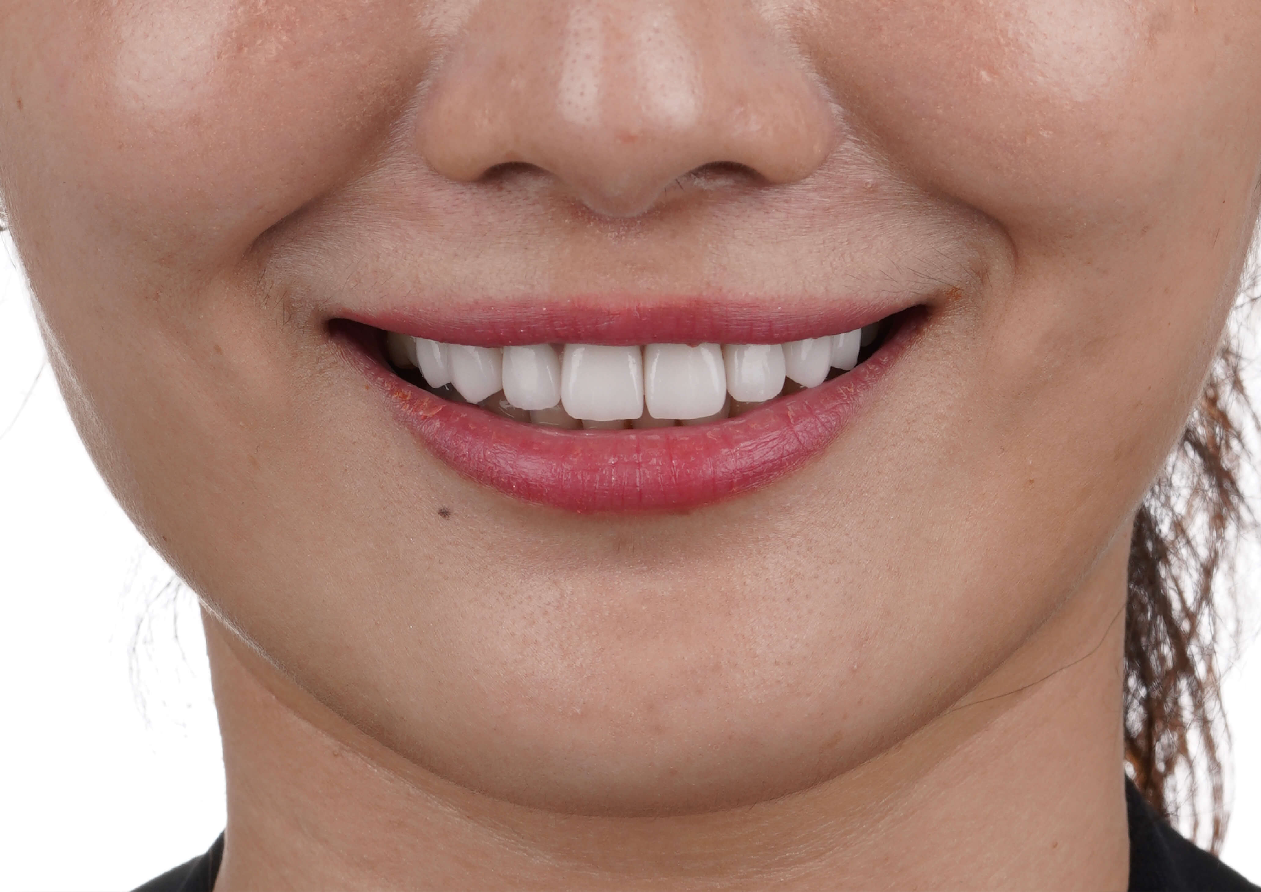 貼片重塑│真愛可以再找.健康不能重來!Alice見證了美齒專業!