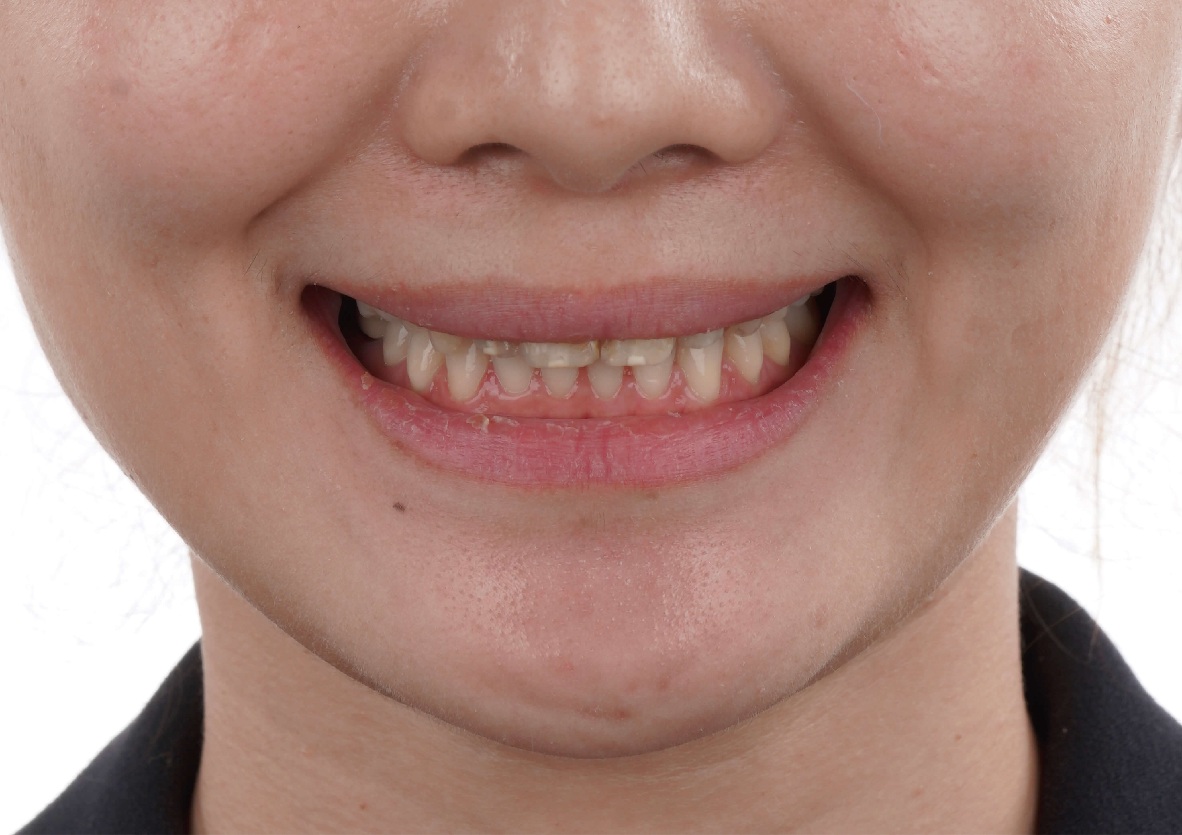 貼片重塑│真愛可以再找.健康不能重來!Alice見證了美齒專業!