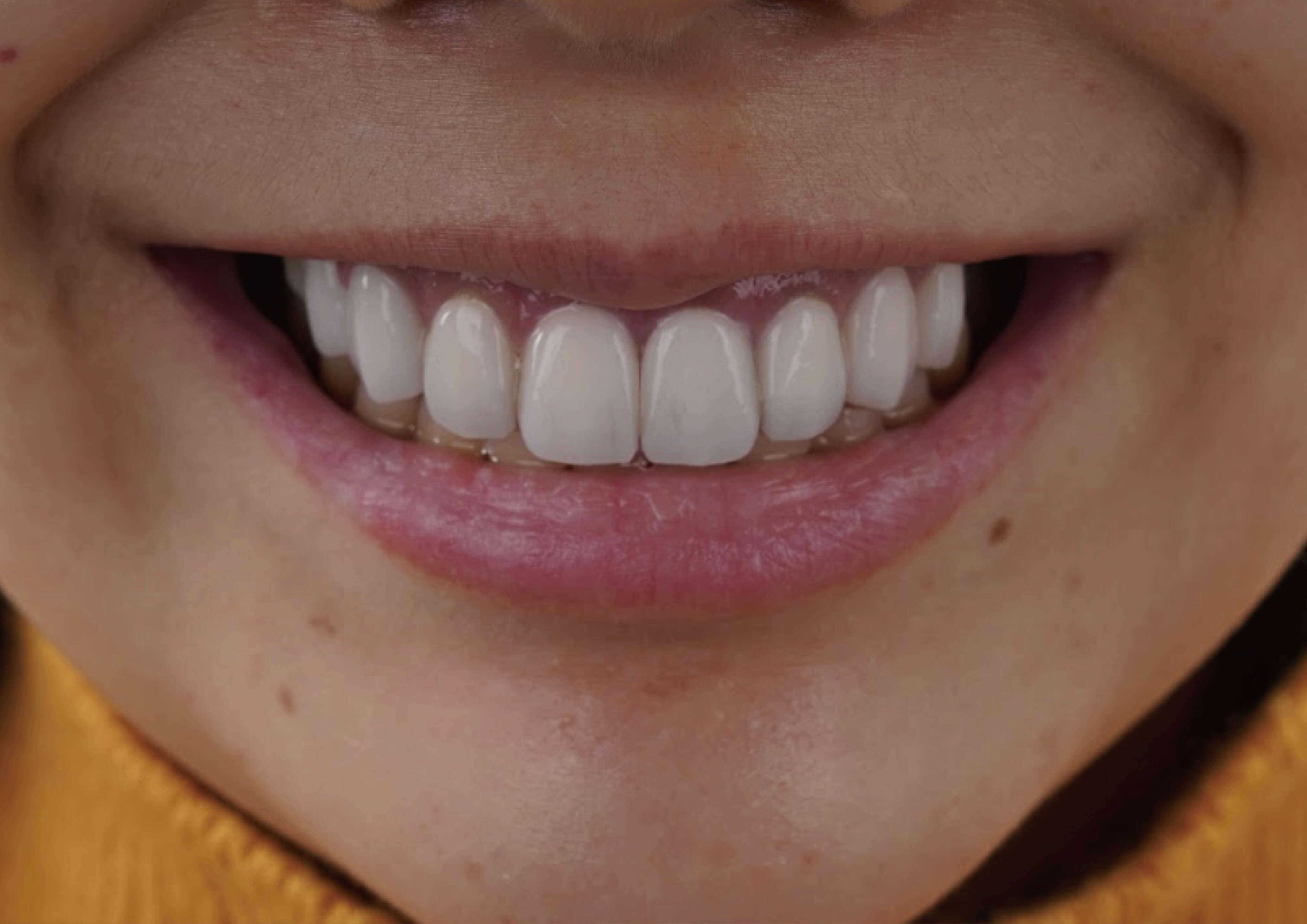 玩美笑容~打造種獨特”IU"的清新甜美!