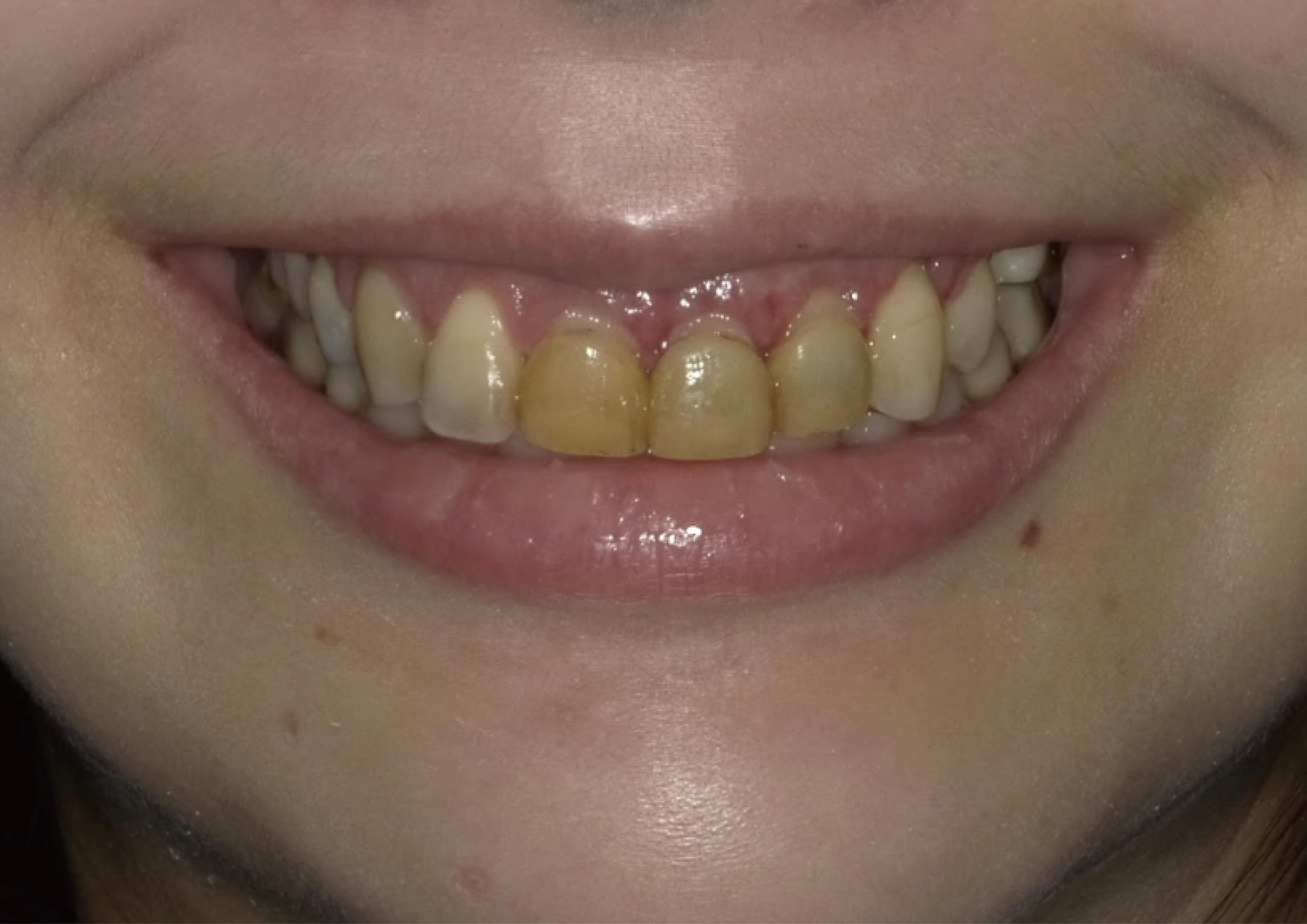 玩美笑容~打造種獨特”IU"的清新甜美!