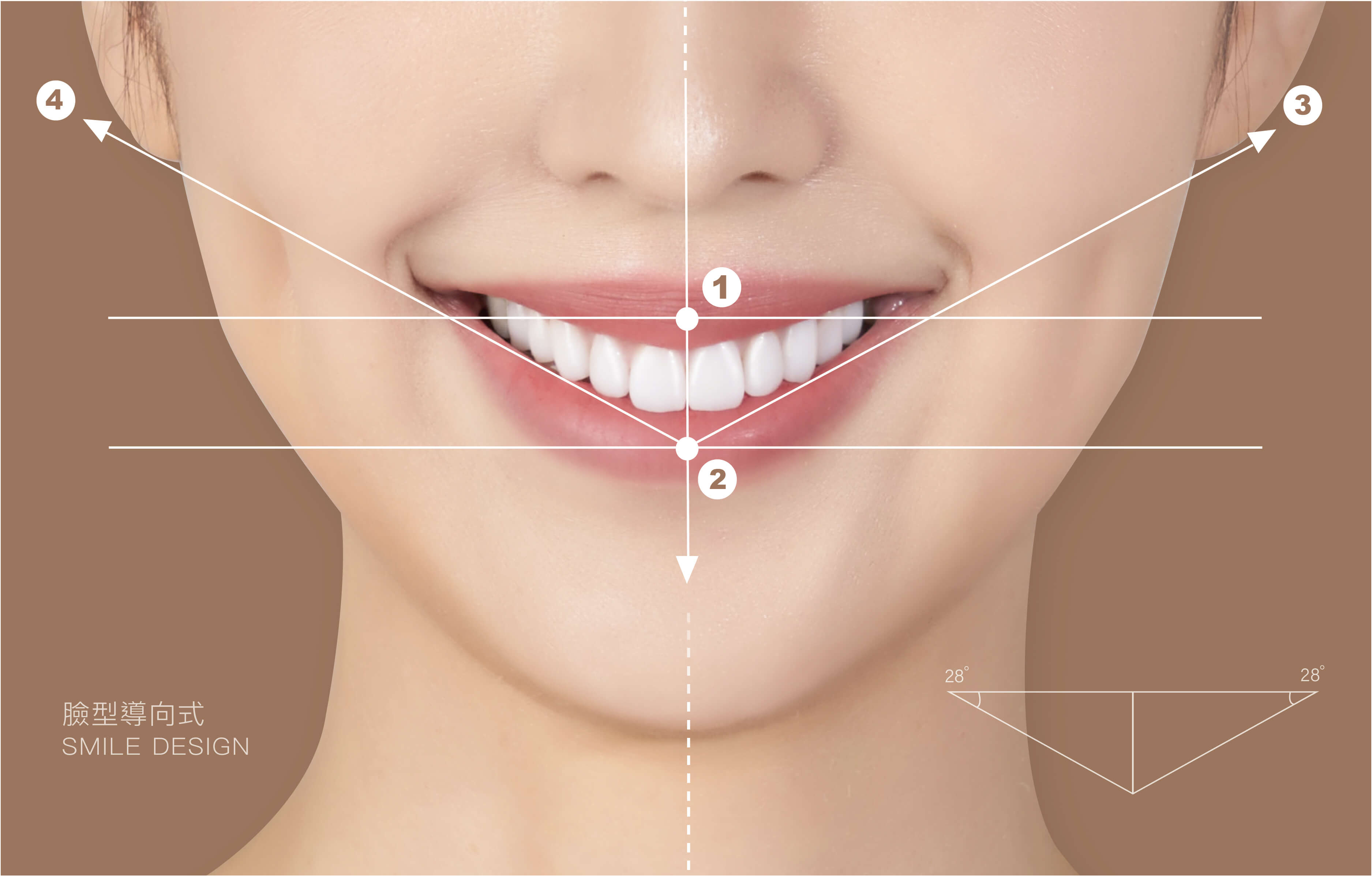V型微笑設計